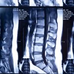 MRI scan of human lumbar spine